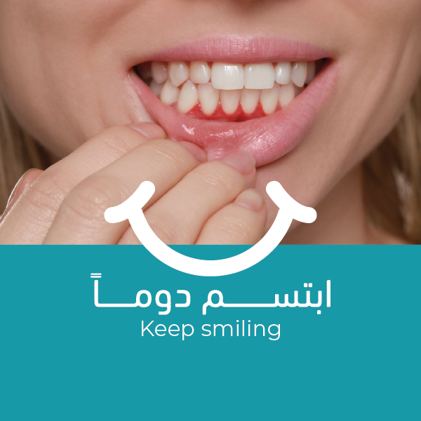 علاج اللثة المتقدم علاج اللثة المتقدم